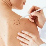 Leia mais sobre o artigo Manchas na Pele: Tipos de Manchas e Quais são Perigosas